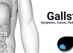 Gallstones- Symptoms, Causes, Risk Factors and Prevention