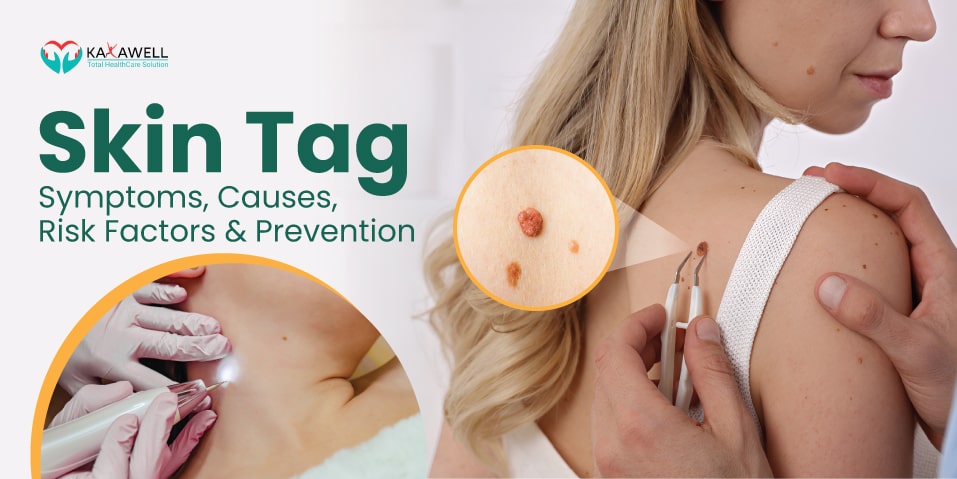 Close-up of skin tags on the back with medical professional using tweezers for removal and a device examining the skin.