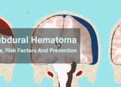 Subdural Hematoma- Symptoms, Causes, Risk Factors and Prevention