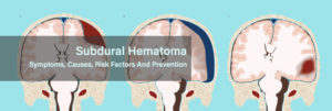 Subdural-Hematoma--Symptoms,-Causes,-Risk-Factors-And-Prevention
