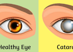 Cataract--Symptoms,-Causes-And-Prevention-Tips