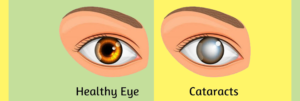 Cataract--Symptoms,-Causes-And-Prevention-Tips