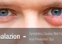 Chalazion- Symptoms, Causes, Risk Factors and Prevention Tips