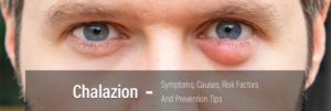 Chalazion--Symptoms,-Causes,-Risk-Factors-And-Prevention-Tips