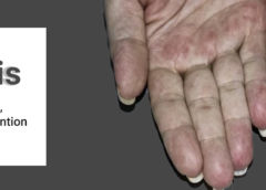 Vasculitis- Symptoms, Causes, Risk Factors and Prevention