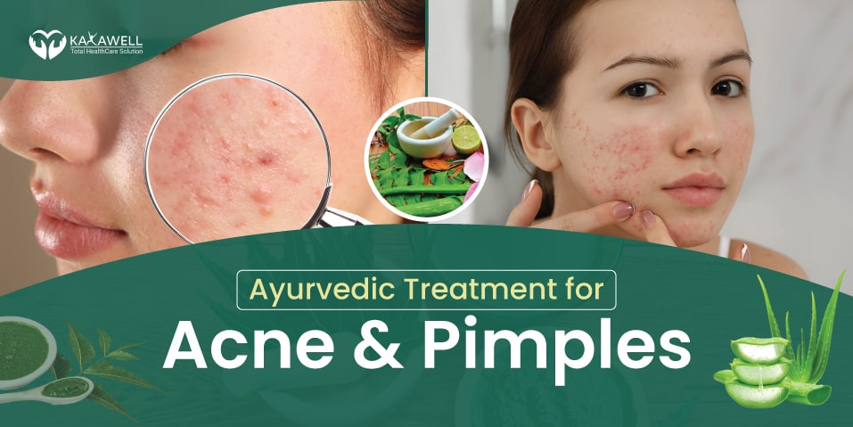 Ayurvedic-Treatment-for-Acne-and-Pimples