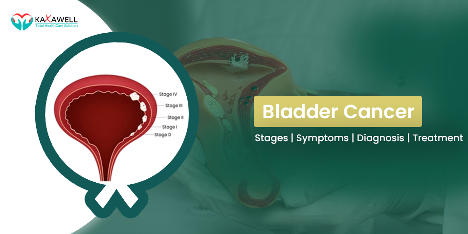 Bladder Cancer Stages | Symptoms | Diagnosis | Treatment
