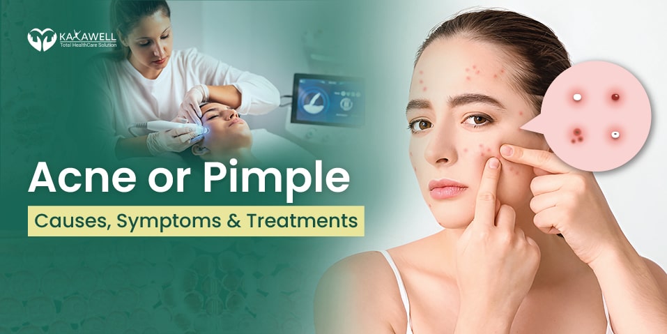 Acne or Pimple, Pimple, Acne ,Oily skin, anxiety ,rash ,