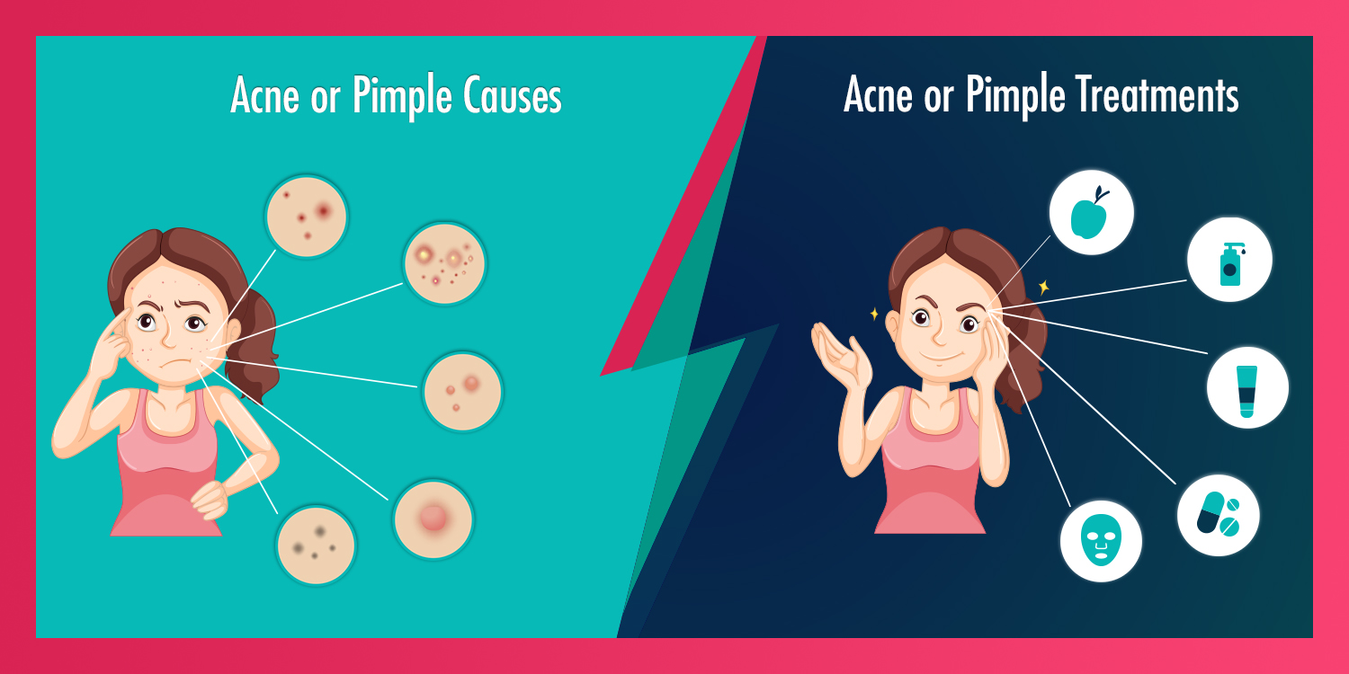 Acne or Pimple, Pimple, Acne ,Oily skin, anxiety ,rash ,