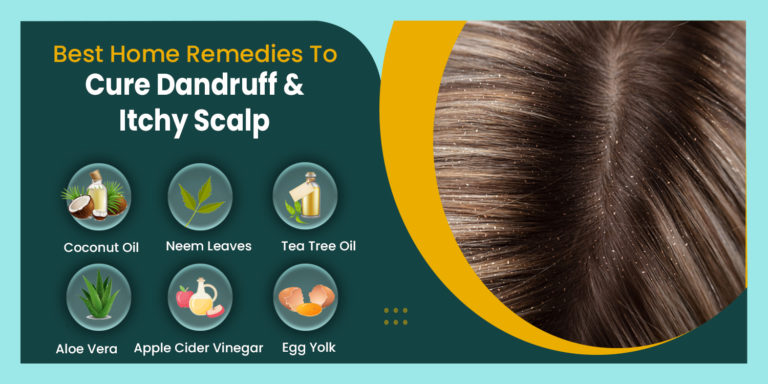 Best 15 Home Remedies To Cure Dandruff And Itchy Scalp