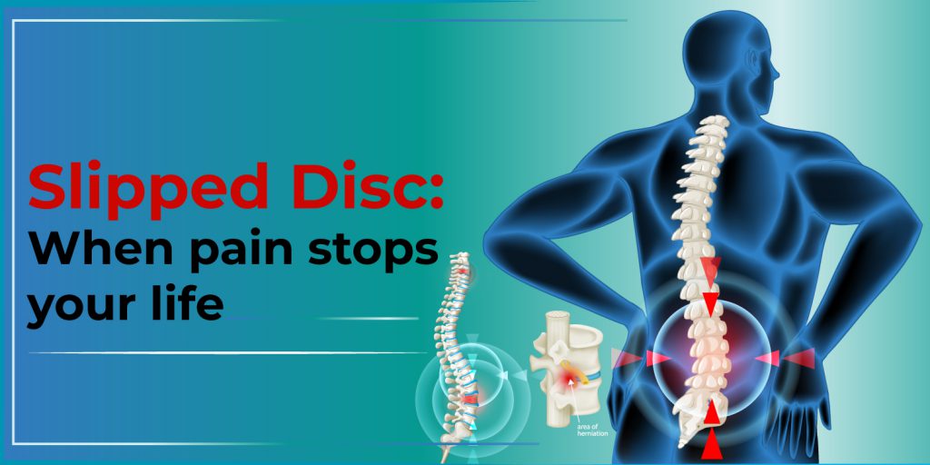 What is herniated disc or slipped disc? Know everything here