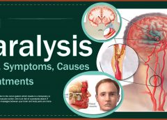 Paralysis: Types, Symptoms, Causes & Treatments