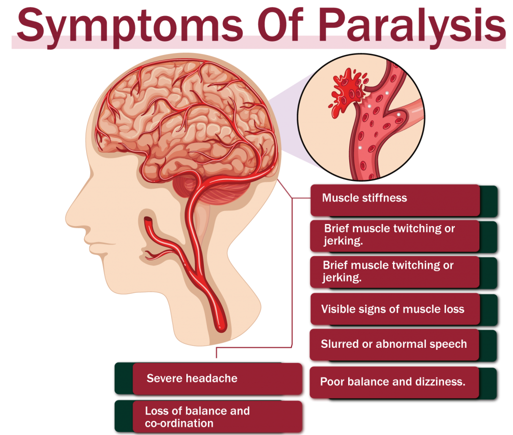 paralysis symptoms
