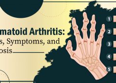 Rheumatoid Arthritis: Causes, Symptoms And Diagnosis
