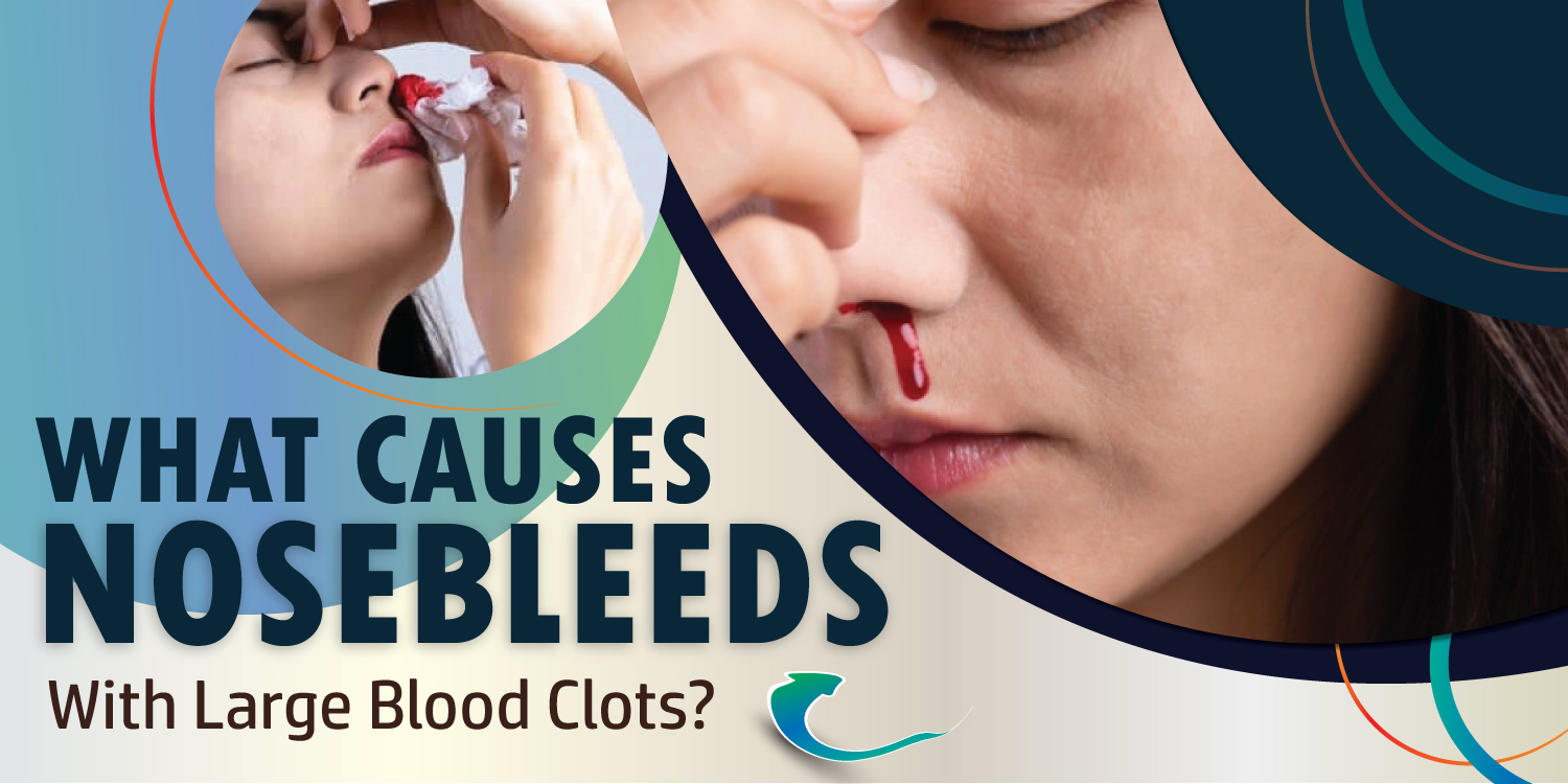 causes of nose bleeding