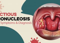 The Complete Guide to Infectious Mononucleosis: Causes Symptoms & Diagnosis