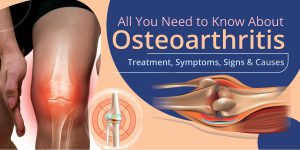 Osteoarthritis Sign & Symptoms