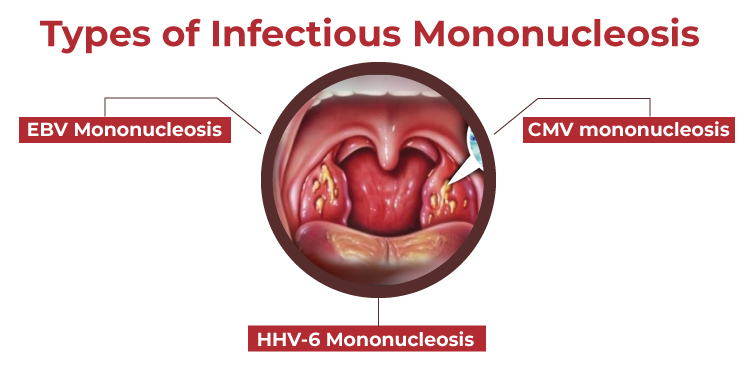 Types of Infectious Mononucleosis