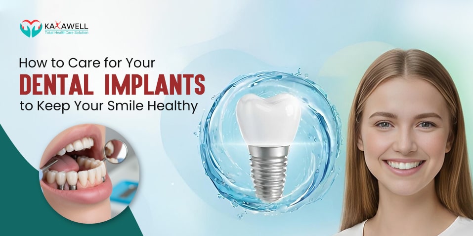 How to Care for Your Dental Implants to Keep Your Smile Healthy?