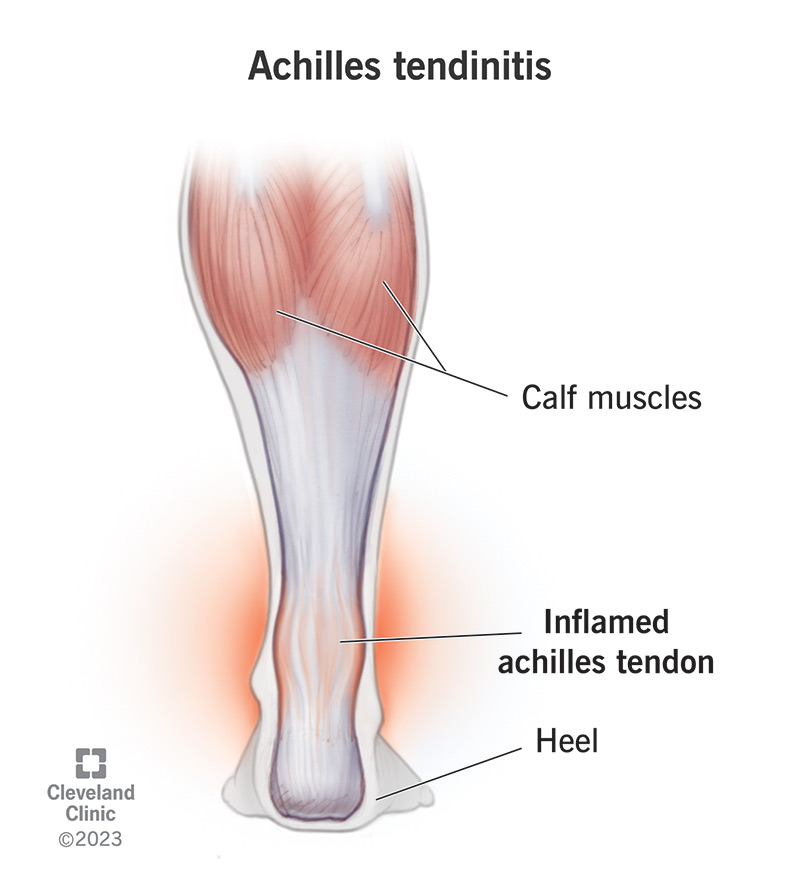cleveland clinic achilles tendon